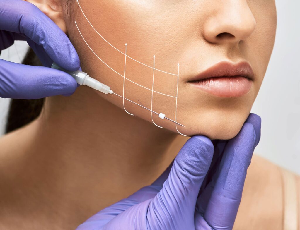 What Is a Cosmetic Thread Lift? 
